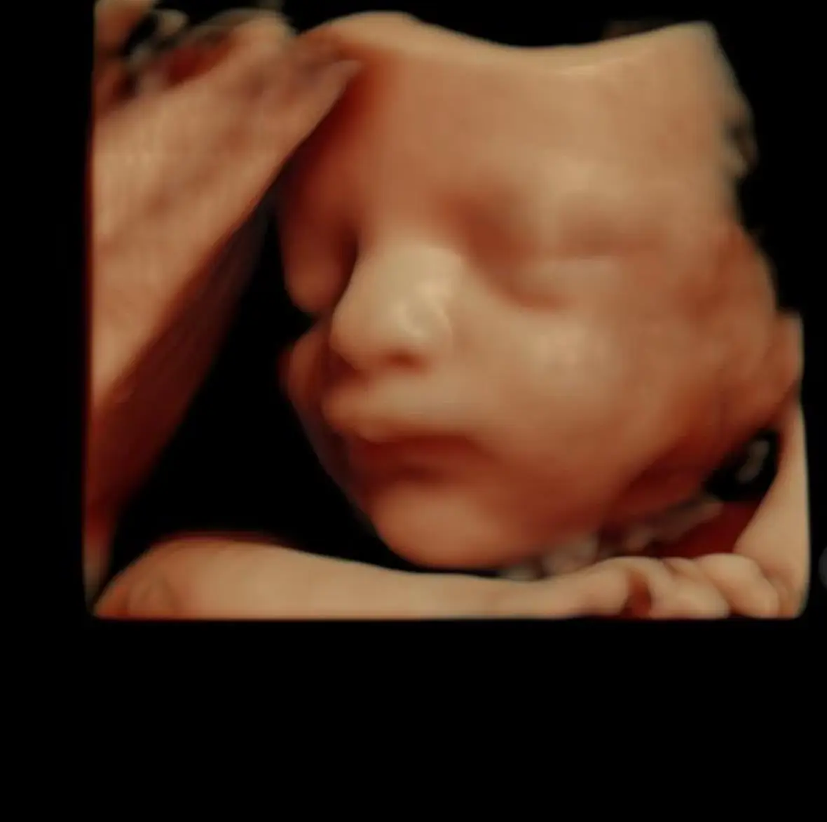 image Scan of baby | obstetric and gynaecological ultrasound near me